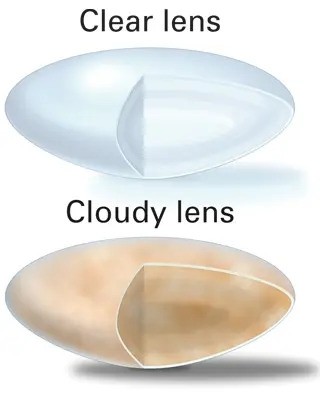 What causes a cataract?