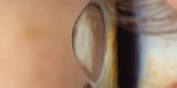 What is keratoconus?