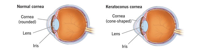 Extracapsular Cataract Extraction